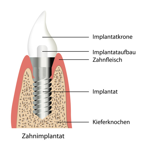 Zahnarzt Wien Zahnimplantate